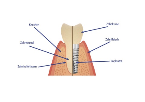 Zahn mit Implantat und Beschreibung